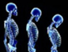 мутации в микрорнк – причина остеопороза